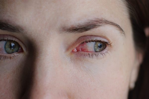 What can I do to get rid of pink eye?