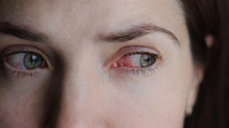What can I do to get rid of pink eye?