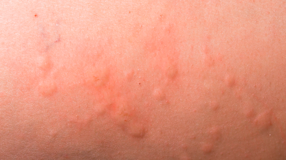 Hives and skin reactions can occur with taking antibiotic
Amoxicillin Rash can look like this