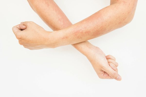 Eczema: Symptoms, Causes, & Treatment