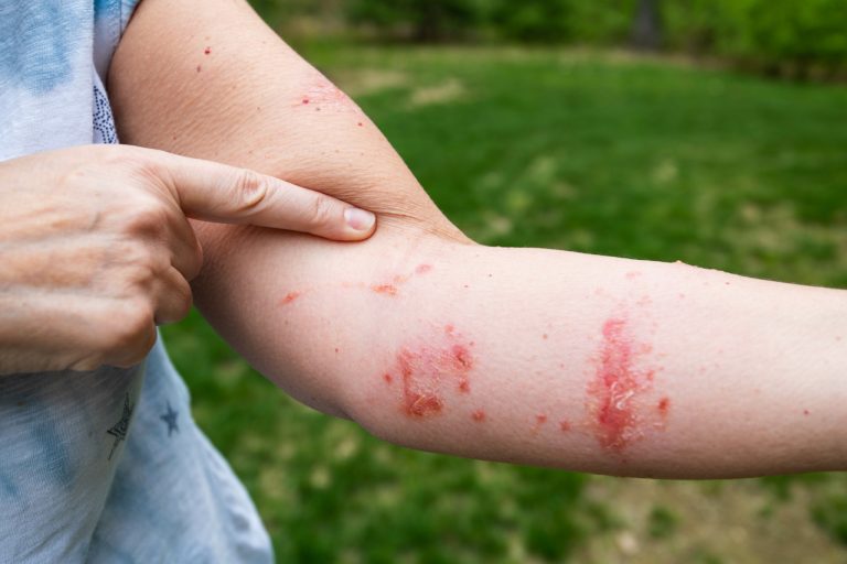 What Does a Poison Ivy Rash Look Like?