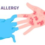 Latex Allergy